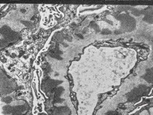 F,74y. | membranous glomerulopathy F,74y. | membranous glomerulopathy